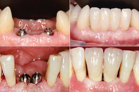 implants dentaires diamètre réduit