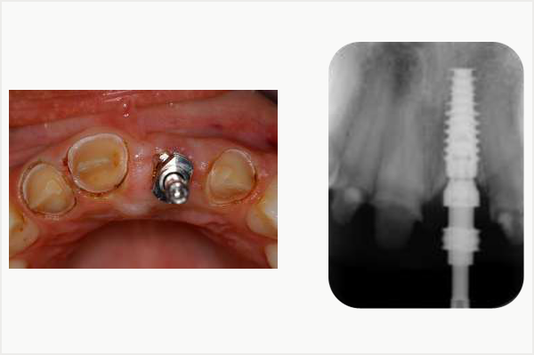 implant, transfert d'empreinte