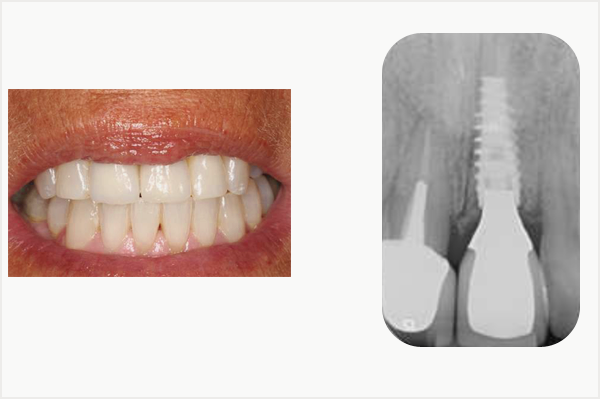 moignon cramis, transviss en bouche et contrl radiographiquement