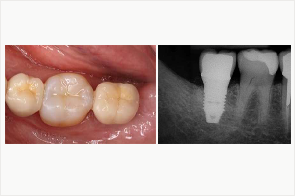 implant dentaire, pilier Procera titane