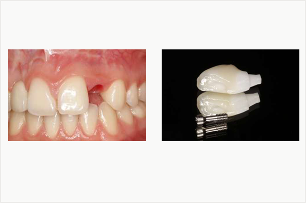 Prothse unitaire transvisse tout cramique avec pilier Procera en zircone individualis