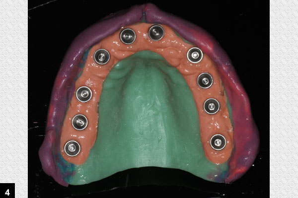 empreinte pltre 8 implants dentaires