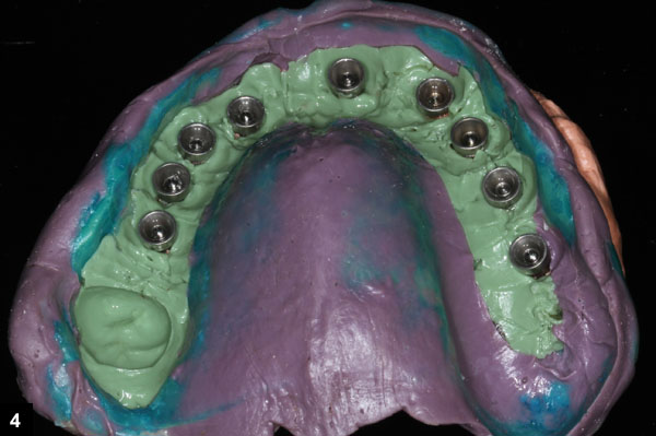 empreinte neuf implants dentaires