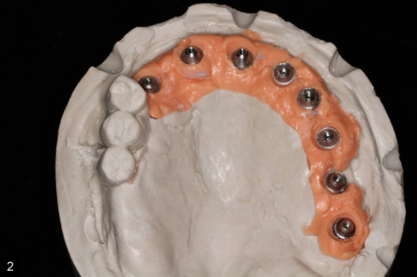 Modele de travail, 8 implants poss