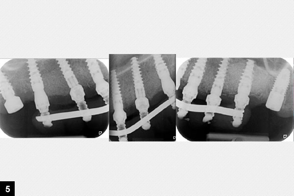 Radiographie de controle, armature