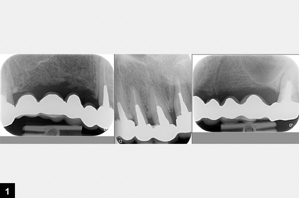 Radiographie panoramique pr-opratoire