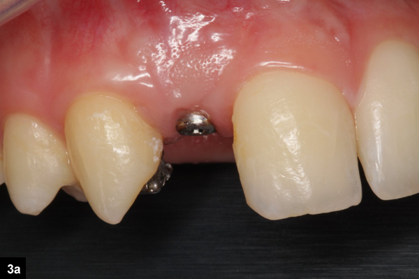 augmentation latérale implant dentaire
