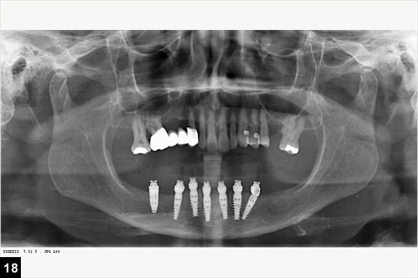 Contrle radiographique de la bonne adaptation du bridge sur tous les piliers