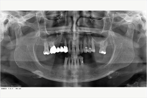 dentement mandibule