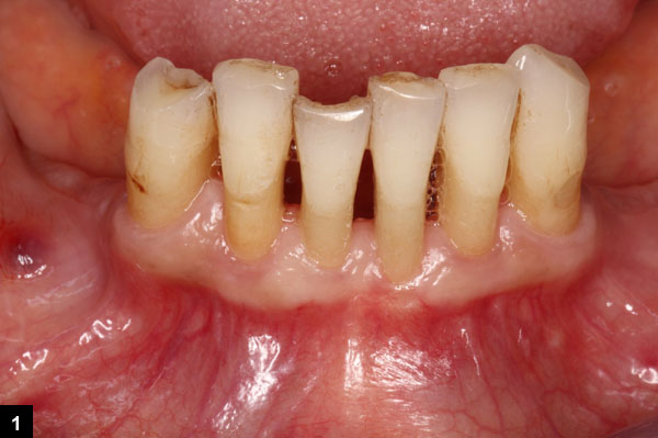 dentement de la mandibule