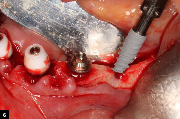 implant dentaire incliné