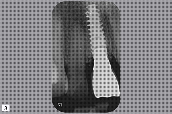 implant incisive