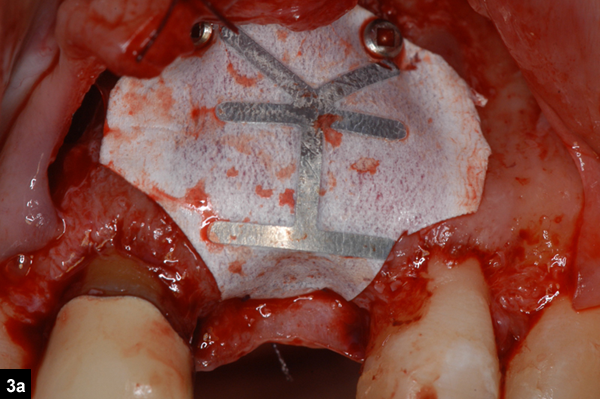 membrane fixée en palatin par une suture