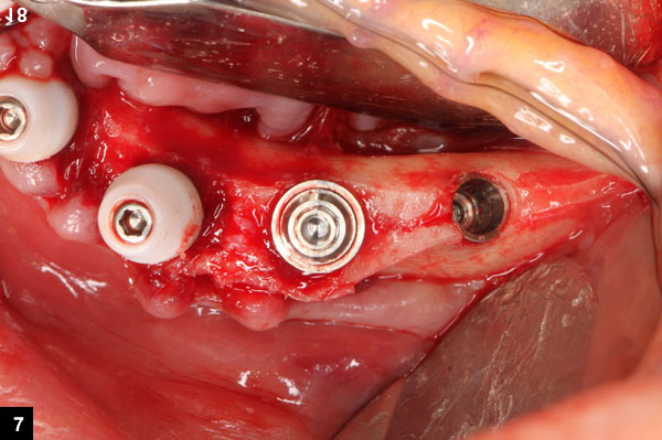 mise en place de l'implant