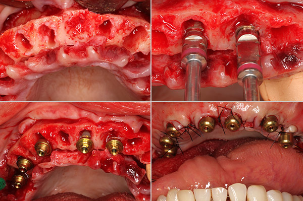 mise en place des implants dentaires