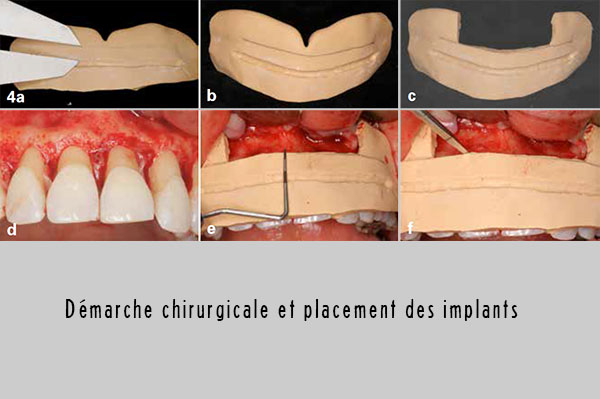 placement des implants