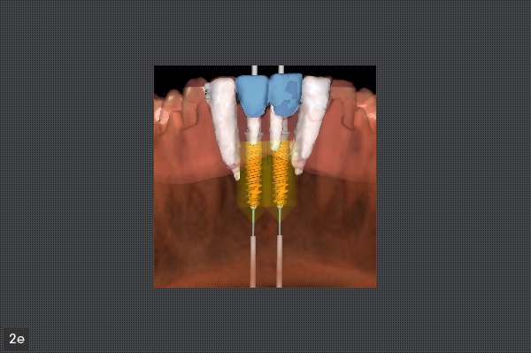 planification informatique des implants et de leur pilier