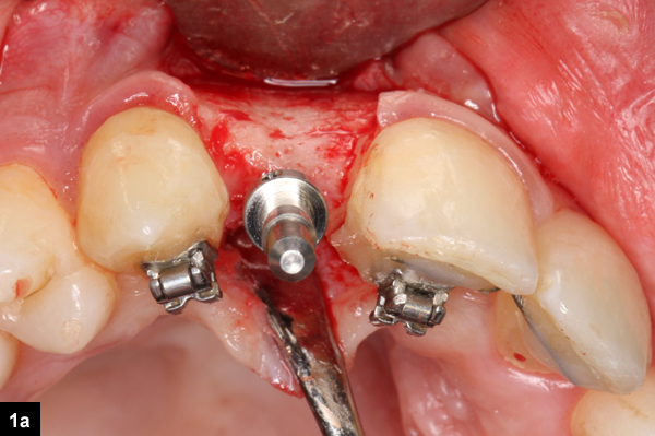 pose de l'implant dentaire
