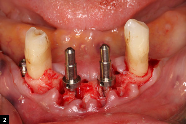 pose des implants dentaires