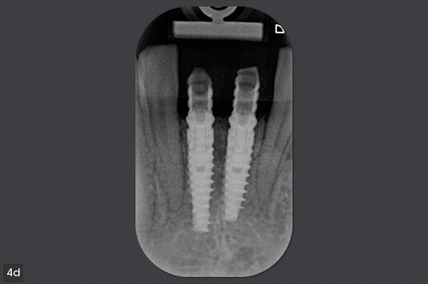 radiographie prothese provisoire