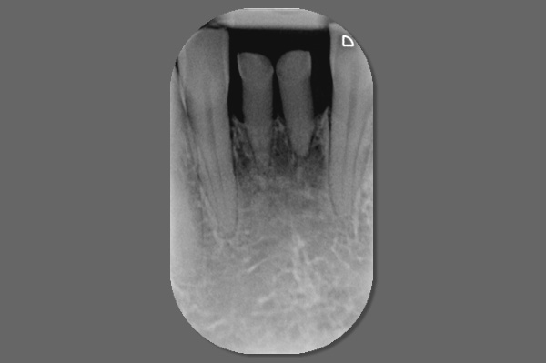 Radiographie rtro-alvolaire