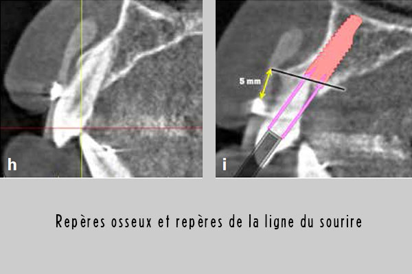 repres squelettiques
et du niveau de la ligne du sourire