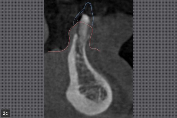 volume osseux