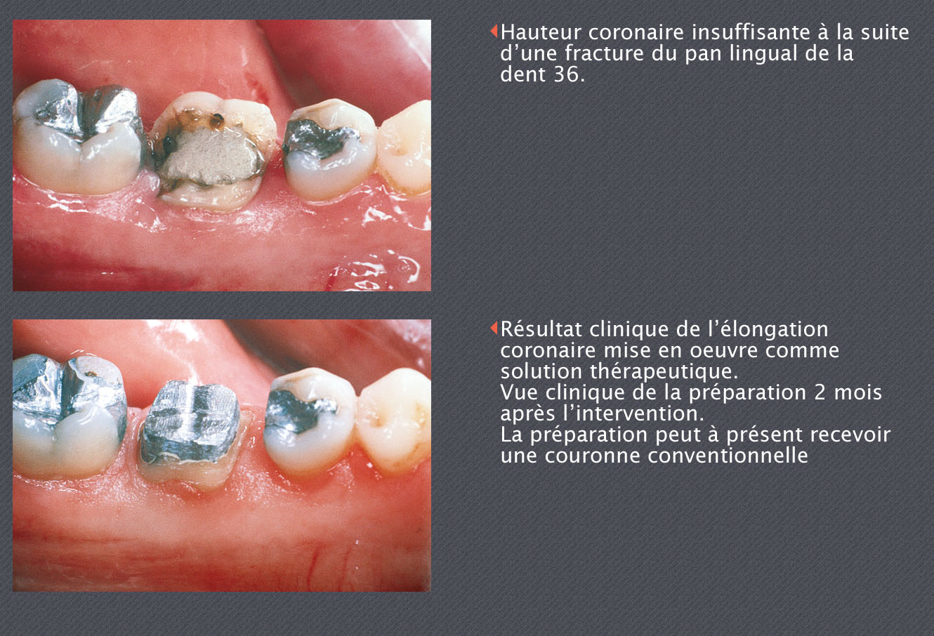 hauteur de la couronne résiduelle