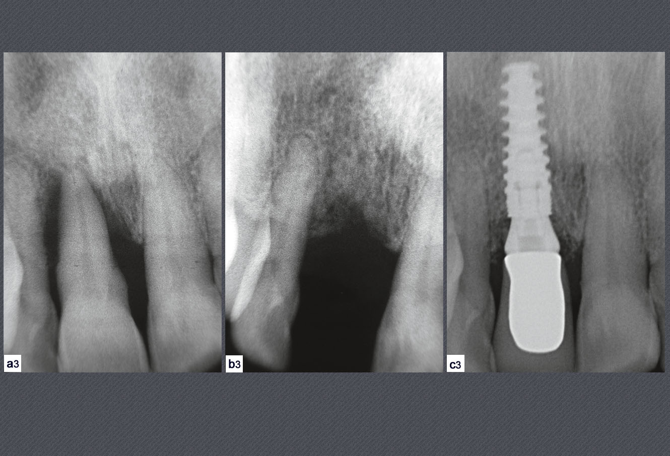 simulation de la pose de l'implant dentaire