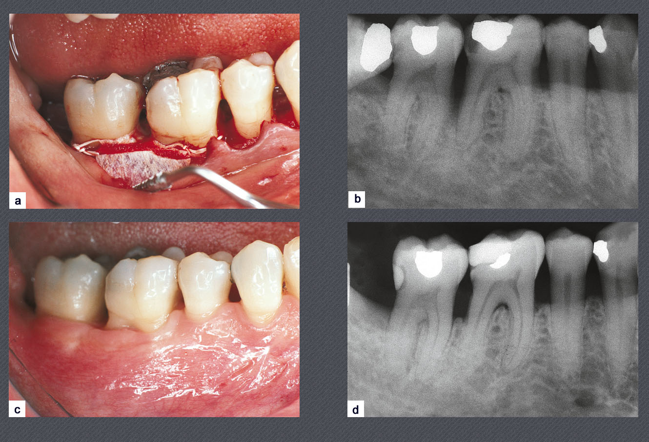 diagnostic pre-implantaire