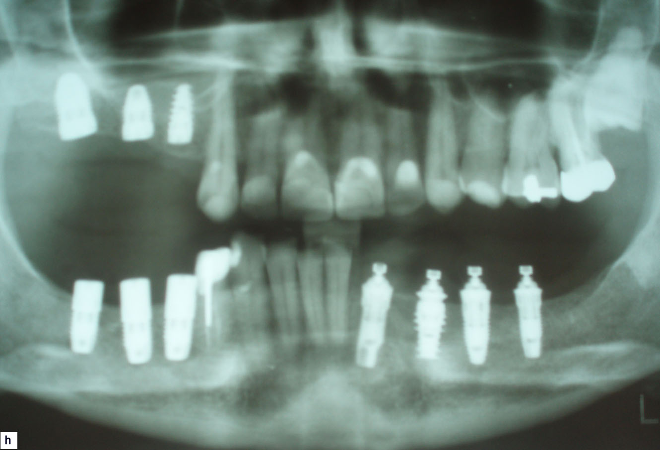 simulation de la pose de l'implant dentaire