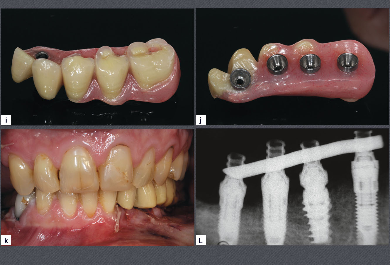 simulation de la pose de l'implant dentaire