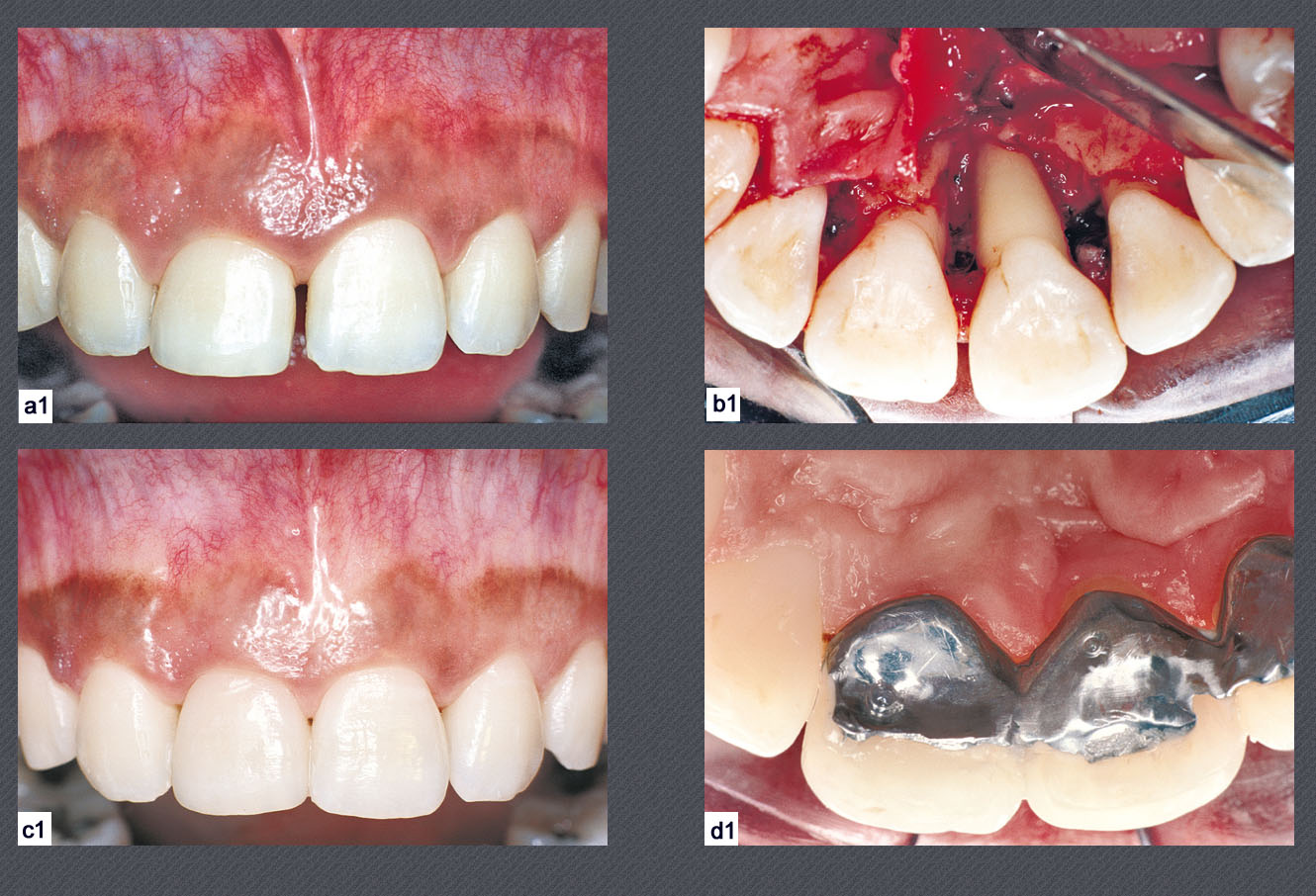 protocole d'extraction