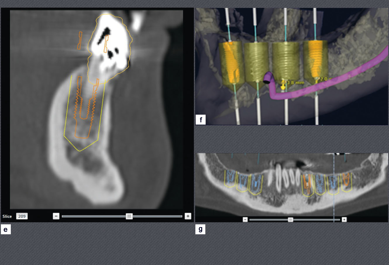 simulation implantaire