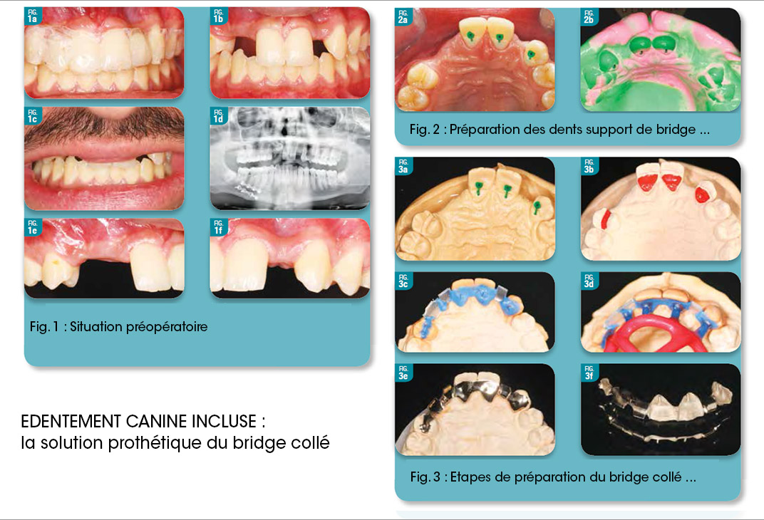 édentement causé par une canine incluse. La solution prothétique du bridge collé