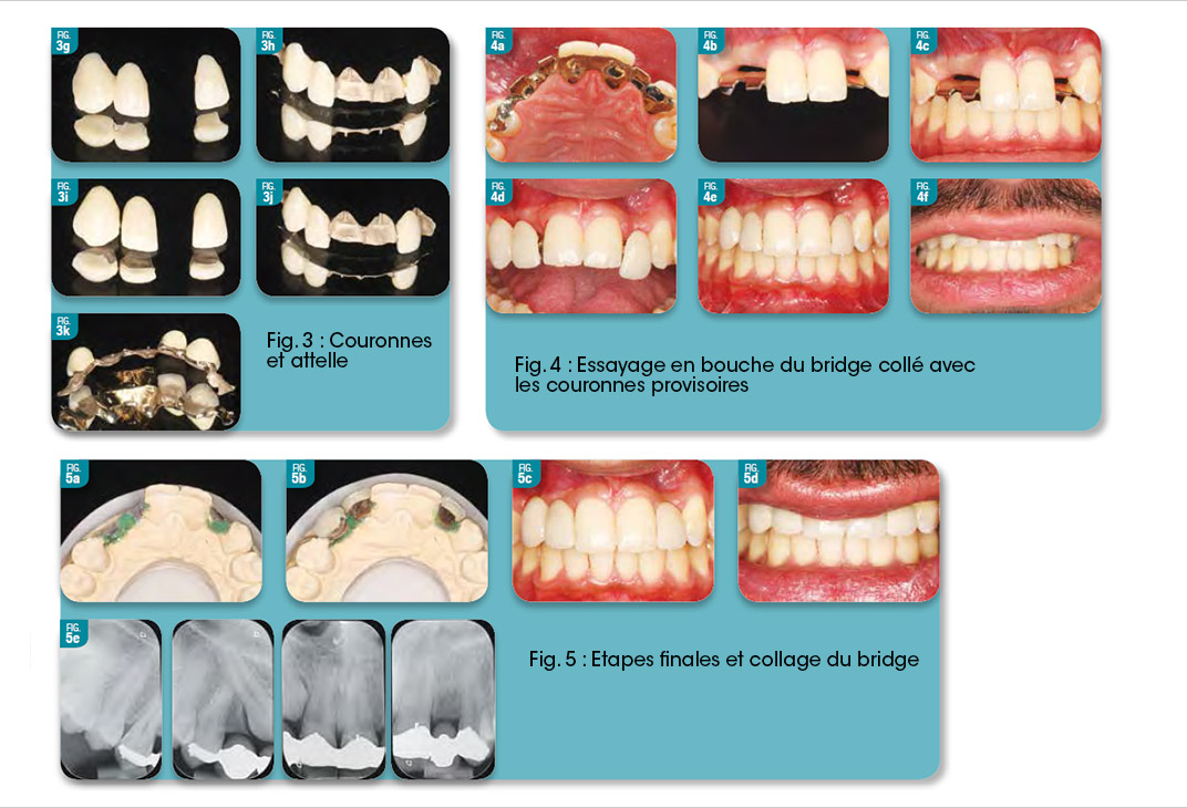 bridge collé avec les couronnes