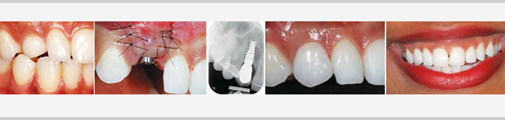 Restauration esthétique édentement canine implant dentaire unitaire