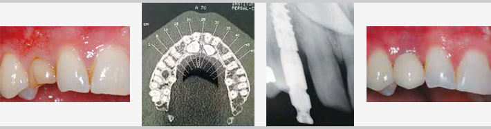 Technique de l'implant trans-corono-radiculaire.