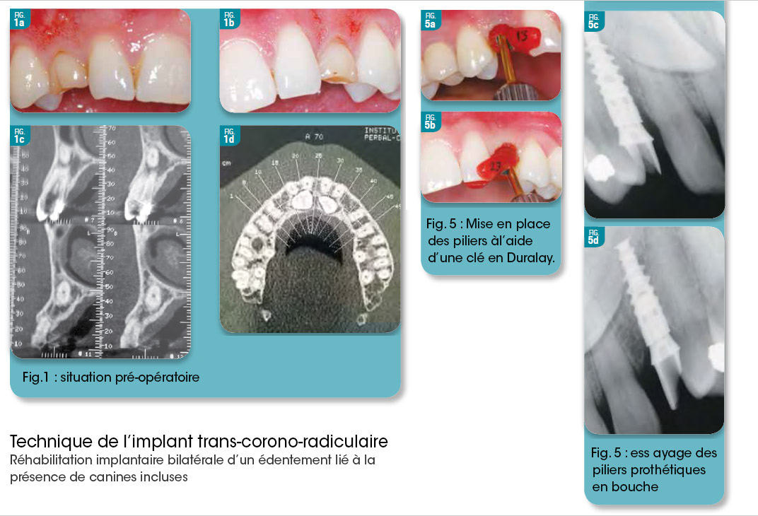 technique de l’implant trans-corono-radiculaire