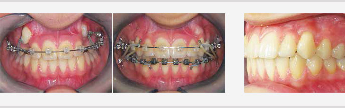Traitement orthodontique bilatéral d’une inclusion haute des 2 canines maxillaires