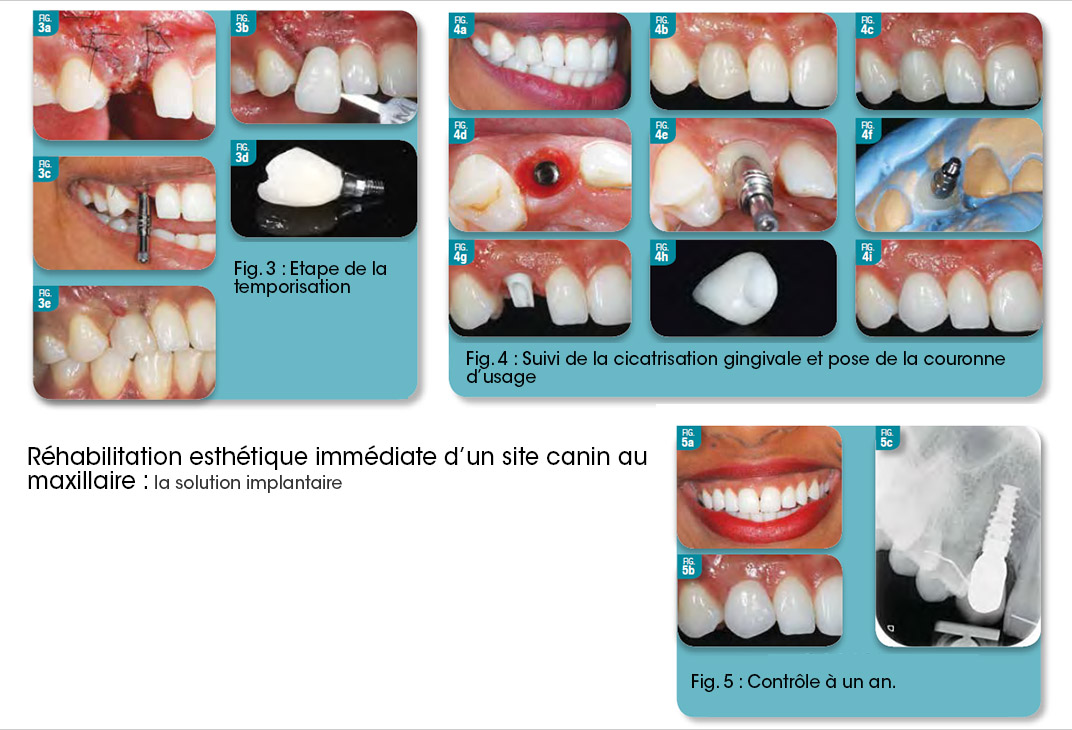 réhabiltation esthétique implant dentaire