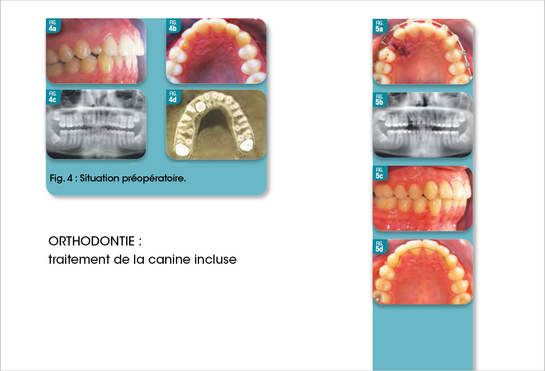 traitement orthodontique canine incluse