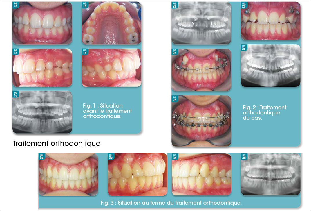 Traitement orthodontique bilatéral d’une inclusion haute des 2 canines maxillaires