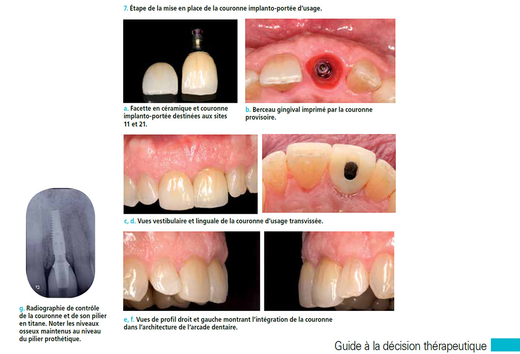 couronne implanto-portee