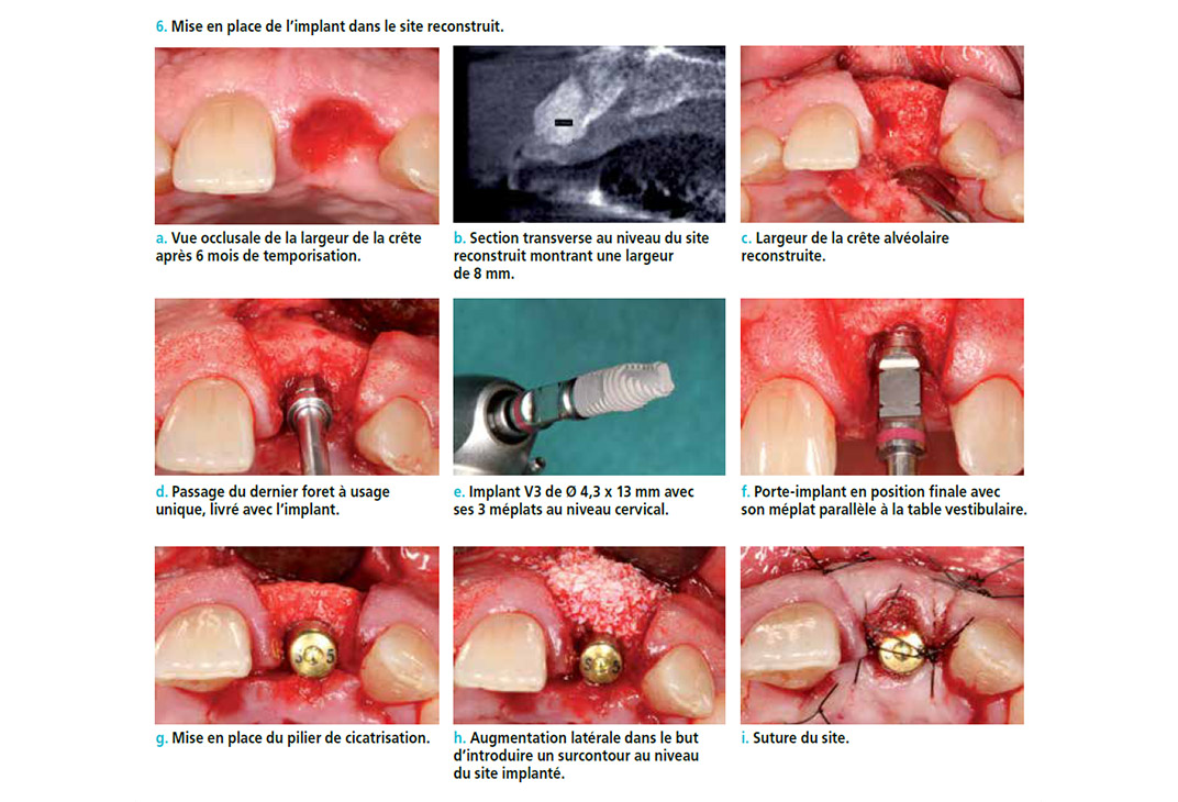 mise enplace de l'implant dentaire