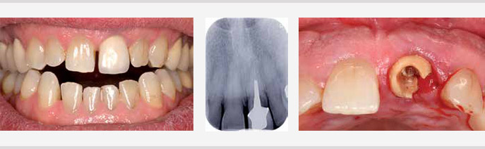 Traitement orthodontique bilatéral d’une inclusion haute des 2 canines maxillaires