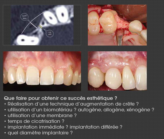 canine implant dentaire