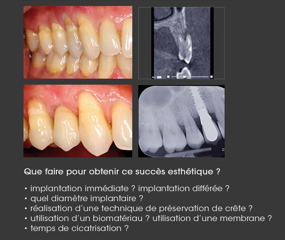 implantation prémolaire