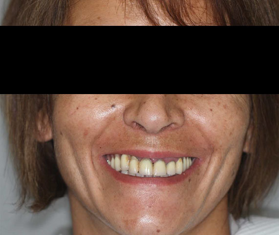 sourire gingival