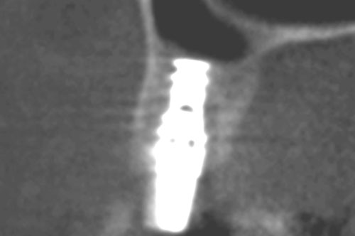 apex de l'implant